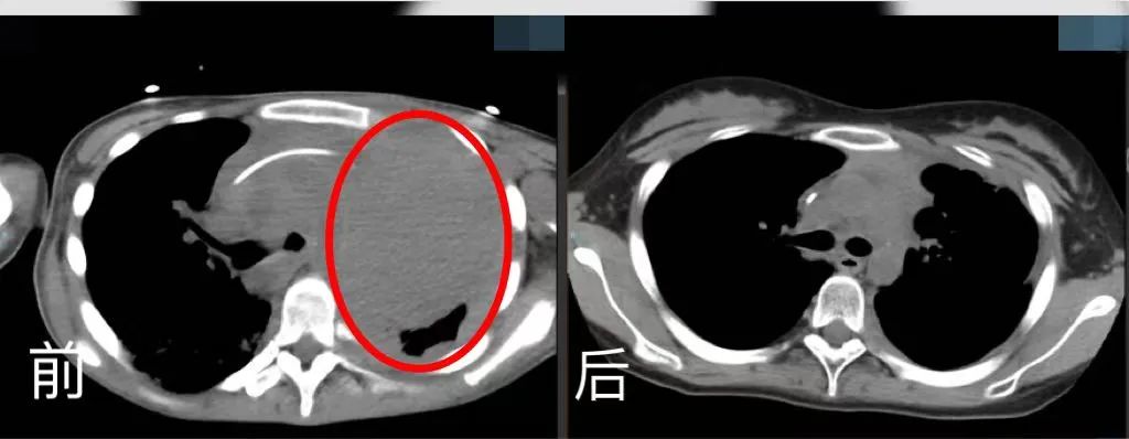 胸腔CT前后對(duì)比。四川省腫瘤醫(yī)院供圖