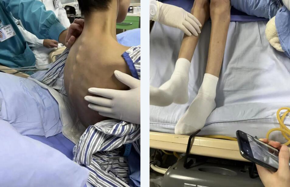 剛?cè)朐簳r(shí)的小玉。四川省腫瘤醫(yī)院供圖